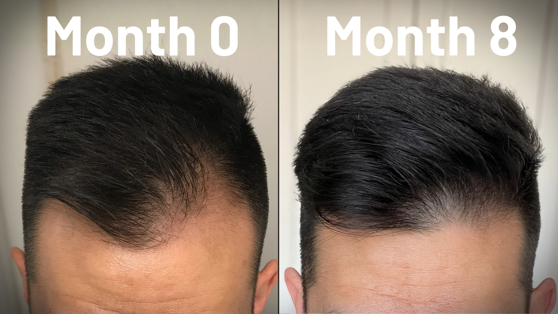 Microneedling for Hairline Restoration: What to Expect